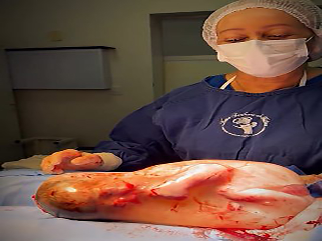 Bebê nasce empelicado e rompe a própria bolsa ao se espreguiçar em Sorriso
